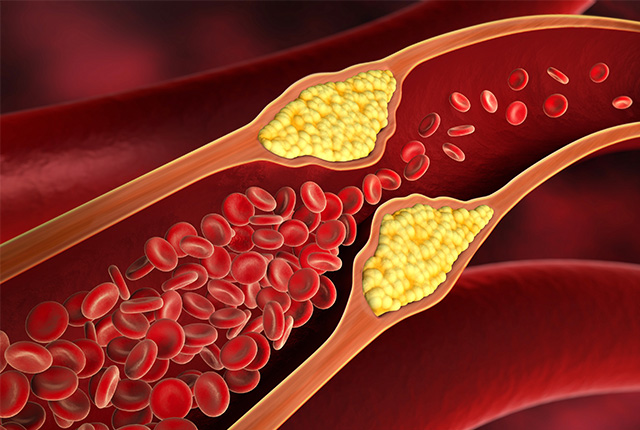 微小高密度LDL(Small-dense LDL)